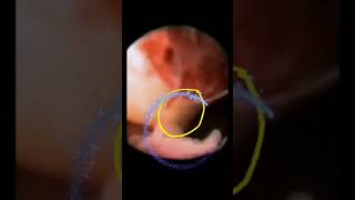 World's first video of live ovulation of a human egg