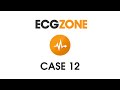 ECG Case 12 - Chest Discomfort with Palpitations