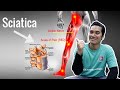 Senaman Untuk Sciatica Pain