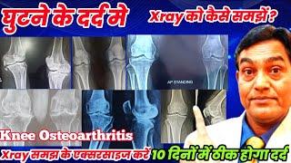 घुटने के दर्द Xray से कैसे समझें कि कौन सा स्टेज का दर्द है । knee osteoarthritis|10 दिनों में ठीक