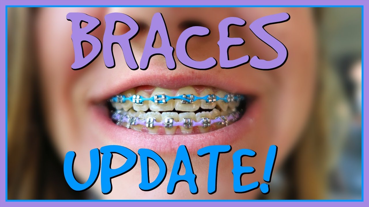 😁 BRACES UPDATE! 😁 - YouTube