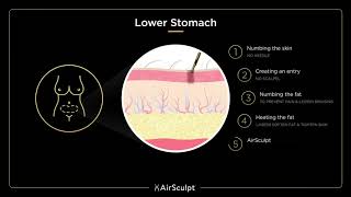 Lower Stomach AirSculpt