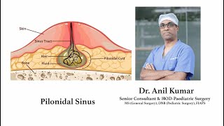 Pilonidal Sinus | Sakra World Hospital