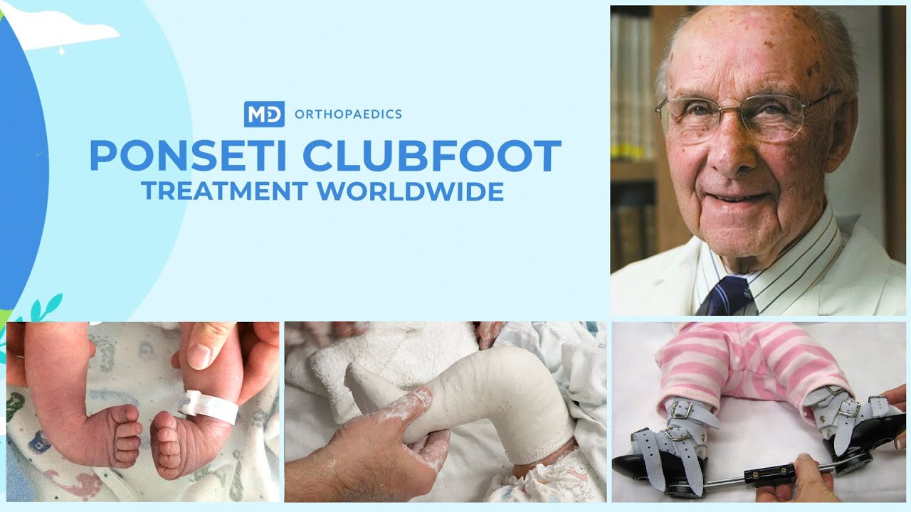 Ponseti Clubfoot Treatment Worldwide - Feature Length Documentary - YouTube