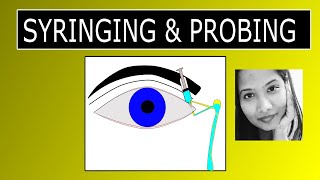 Lacrimal Syringing \u0026 Probing | Procedure \u0026 Interpretation of Results