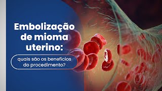 Embolização de mioma uterino: quais são os benefícios do procedimento?