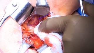 Quadrilateral Space Syndrome: Surgical Technique for Open Decompression