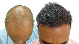 Grade 7 Baldness - 4300 Grafts Result | Hair Transplant Raipur | FUE + Sapphire |