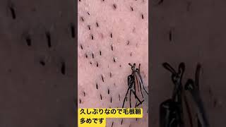 1分間ヒゲ抜きチャレンジ【毛抜き職人のショート動画】頬ヒゲ抜き②毛根鞘多め