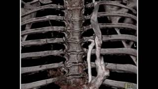 Cardiac: Persistent left superior vena cava emptying into coronary sinus (3 of 4)