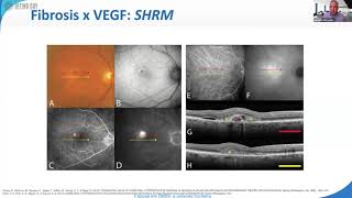 Retina Day 2020 | Bloco 1 DMRI | Laurentino Biccas Neto