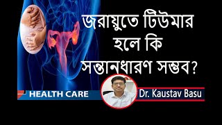 জরায়ুর টিউমারের লক্ষণ ও চিকিৎসা | Uterine fibroid - causes, symptoms, diagnosis & Modern treatment