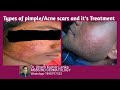 Acne scar/treatment of scars on face /brana ka dag/(Pimple scars ka sabse achha treatment kya he?)