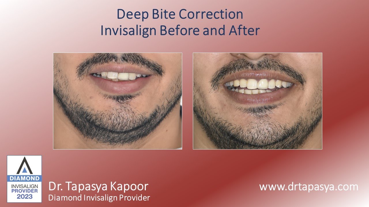 Deep Bite Correction : Invisalign Before And After - YouTube