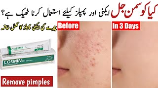 How to Remove Face Acne and Pimples at Home | Cosmin Gel review | Acne Treatment at Home