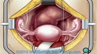PreOp® Hysterectomy Removal of the Uterus Surgery