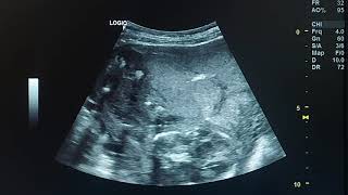 anhydramnios and potter syndrome ultrasound