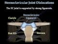 Sternoclavicular  joint Dislocations - Everything You Need To Know - Dr. Nabil Ebraheim