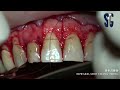 Crown lengthening with apicoectomy & GBR