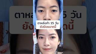 ตาหลังทำ 15 วัน ยังปังขนาดนี้ #inzclinic #inZeye #ศัลยกรรมตา #จักษุแพทย์ #ทําตาสองชั้น #ตาสองชั้นinz