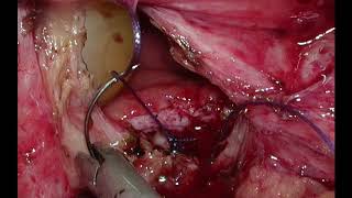 Laparoscopic Recurrent Vesico-Vaginal Fistula Repair by AINU Techniqque