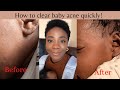 BABY SKINCARE AND ACNE👶