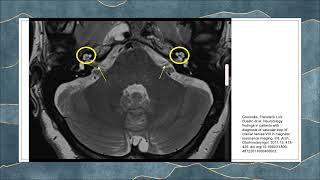 Vascular Loops: are they significant? - Dr Carren Teh Sui Lin