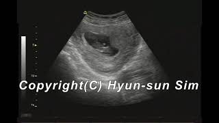 Missed abortion  Ultrasound/계류 유산 (비정상 임신)