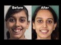 BRACES | before and after | BEST SMILE TRANSFORMATION | Gummy smile | smile design | mini implants