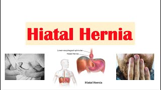 Hiatal (Hiatus) Hernia | Risk Factors, Types, Signs & Symptoms, Diagnosis, Treatment