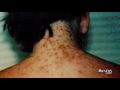 Sea Lice Outbreaks on the Rise in Beaches