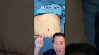 How I Remove Skin After Massive Weight Loss! #shorts #abdominoplasty