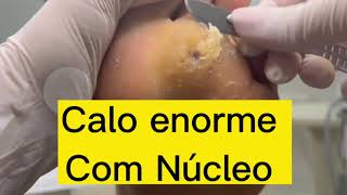 CALO COM NÚCLEO ENORME!!! DESBASTE PLANTAR!!!!