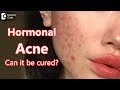 Can Hormonal Acne be cured? - Dr. Rasya Dixit