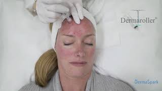 eDermastamp Micro-needling technology