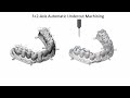 moduleworks dental cam 3 2 axis automatic undercut finishing constant z