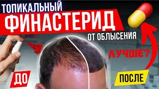 АЛЬТЕРНАТИВА ТАБЛЕТКАМ? ЖИДКИЙ  ФИНАСТЕРИД ЛУЧШЕ? ЖИДКИЕ ФОРМЫ АНТИАНДРОГЕНОВ