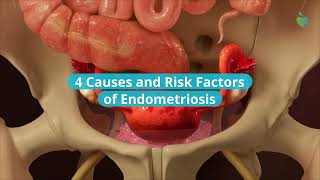 4 Causes and Risk Factors of Endometriosis