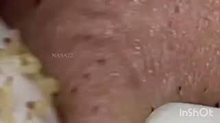 Extraction gros points noirs.Extraction of large blackheads.