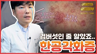 한공각화증, 땀구멍각화증 - 궁금할만한 것과 치료에 대해 / 연세에이앤비 피부과 이해진원장