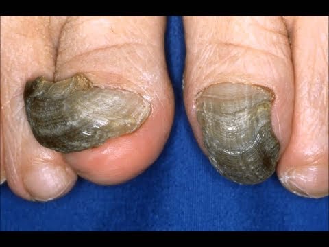 How to Get Rid of Black Toenail Fungus in Half the Time How to Get Rid of Black Toenail Fungus in Half the Time