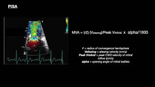 Mitral stenosis