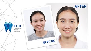 คุณแหม่ม บัวชมพู  สีหอมเหิน(Dental Assistant) กับการจัดฟันแบบใส Invisalign by Black Diamond Provider