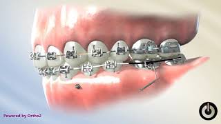 TAD for Mesializing Lower Molar | Dental Braces | Temecula Valley, CA