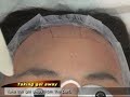 jeisys forehead line part treatment smoothcool