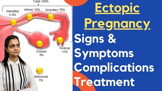Ectopic Pregnancy In Hindi | Ectopic Pregnancy क्या होती है, लक्षण और कारण क्या है ?