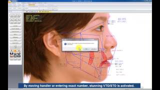 Cephalometric Analysis Software : V-Ceph