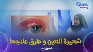 الشروق مورنينغ| شعيرة العين 