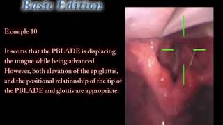 Video Laryngoscope Airway scope(AWS) - Basic edition example10