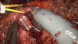 ROBOTIC LEFT HEPATECTOMY